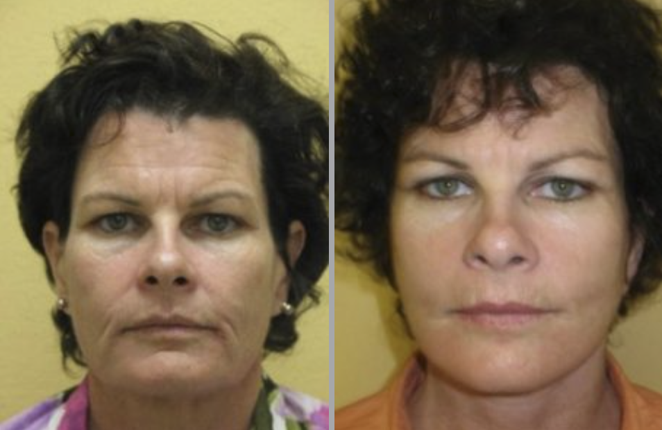 Facelift in Ventura, CA